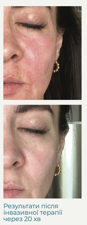 Реальний результат застосування Activation Serum NMN через 20 хв після інвазивної терапії